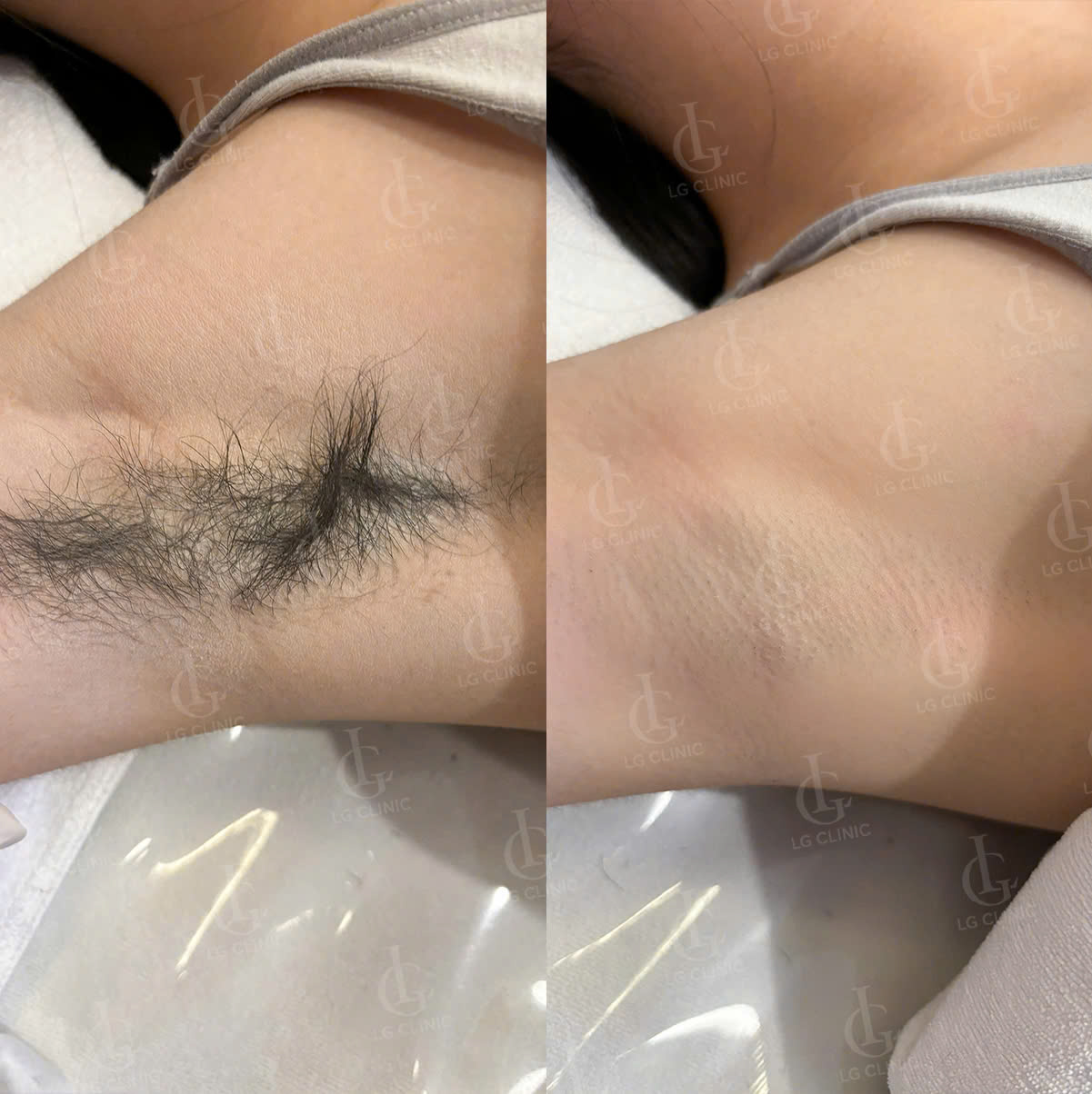 Wax lông nách có bị thâm không