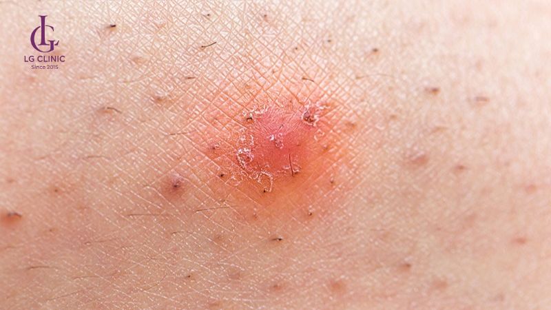 các cách loại bỏ lông mu tại nhà có thật sự hiệu quả không