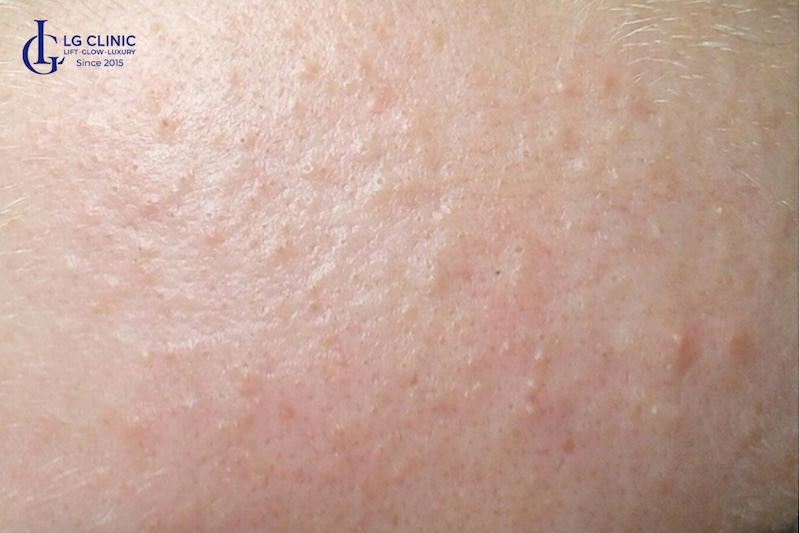 cách đẩy mụn ẩn