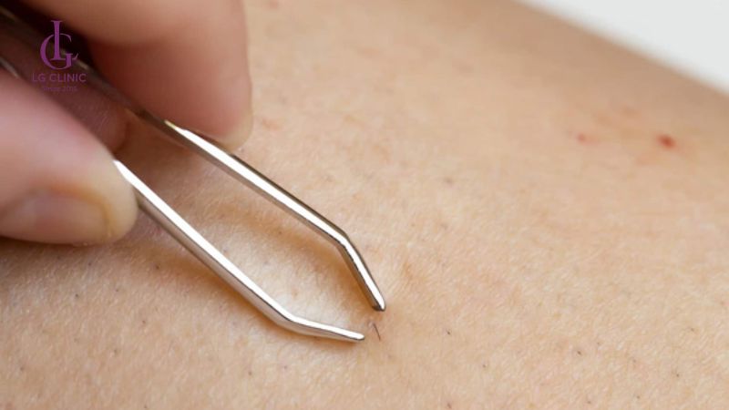 cách nhổ lông mu tại nhà