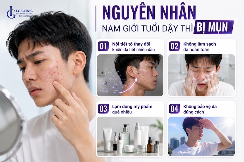 nguyên nhân gây mụn tuổi dậy thì