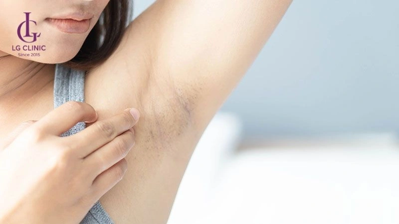 vệ sinh sai cách làm thâm nách