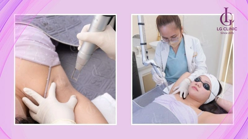 Trị thâm nách bằng laser