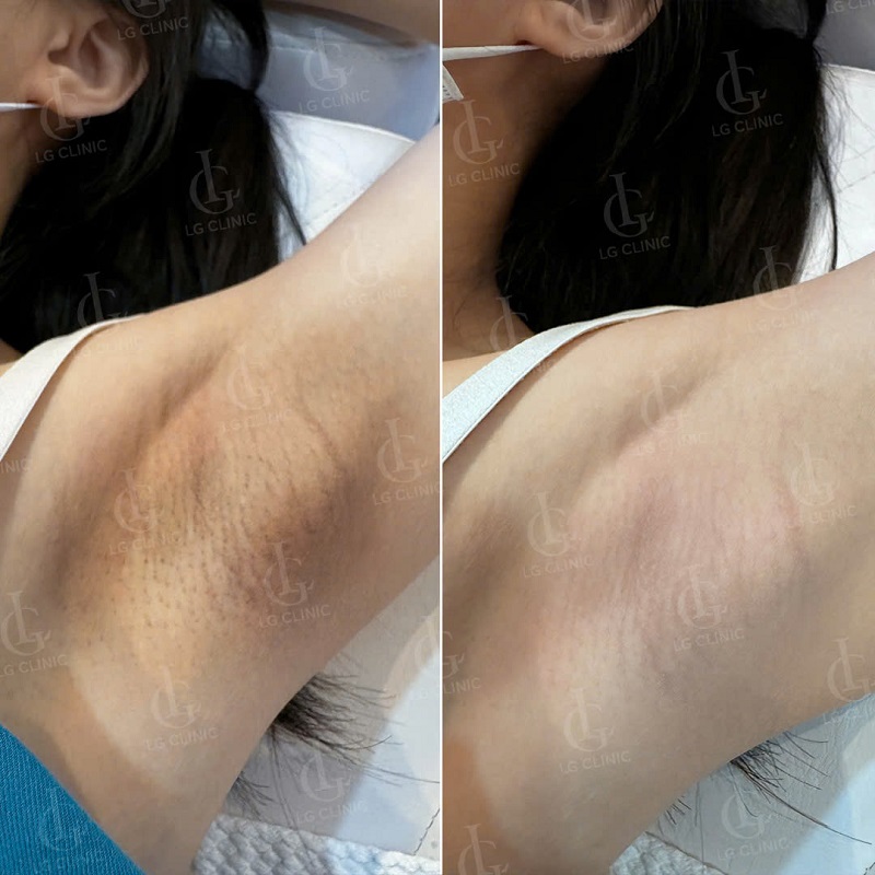 Hình ảnh sau khi trị thâm nách bằng Laser tại LG Clinic