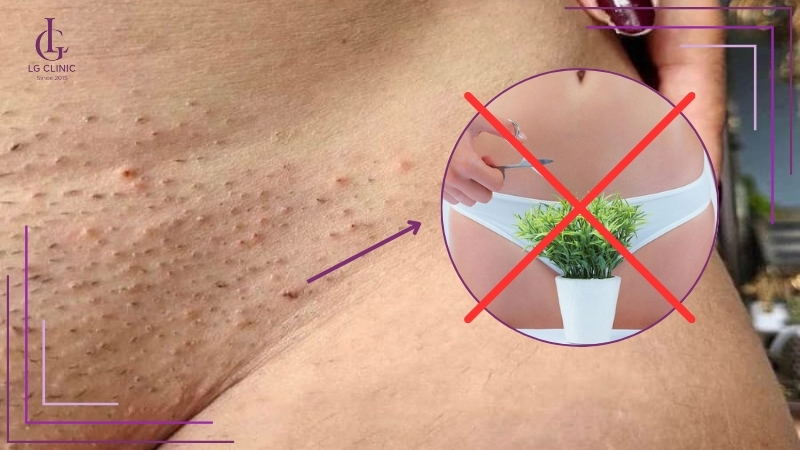 lưu ý khi thực hiện các cách loại bỏ lông mu tại nhà