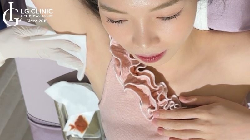 trị thâm nách bằng laser