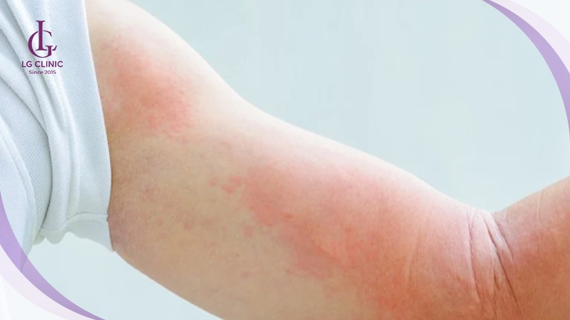 Làn da nhạy cảm rất dễ bị ửng đỏ, nổi mẩn ngứa