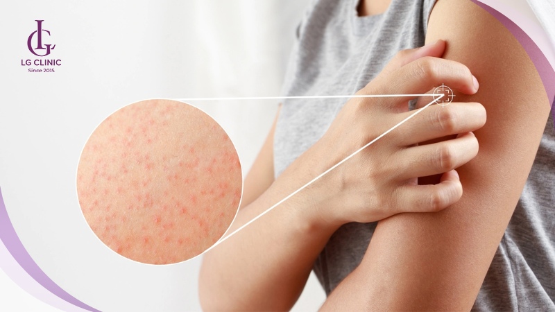 Da nhạy cảm bị viêm nang lông và nổi mẩn đỏ sau khi triệt lông