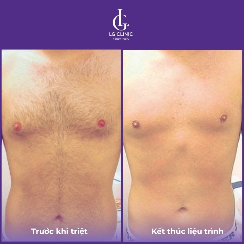 hình ảnh triệt lông ngực