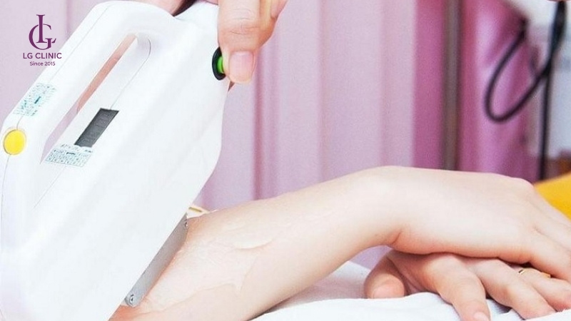 Triệt lông tay vĩnh viễn bằng công nghệ Laser Diode hiệu quả cao