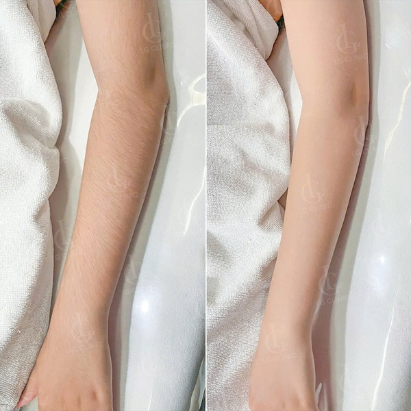 triệt lông tay vĩnh viễn