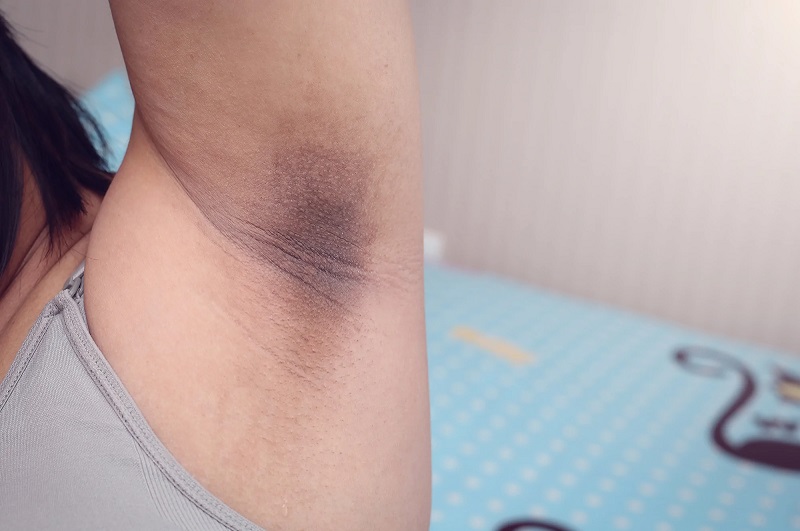 Nách của trẻ bị thâm - cách trị thâm nách ở tuổi dậy thì