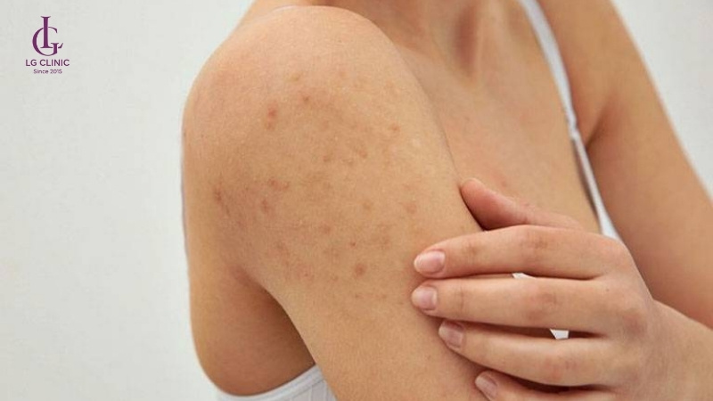 Chăm sóc da đúng cách khi triệt lông giúp ngăn nguy cơ bị viêm lỗ chân lông.