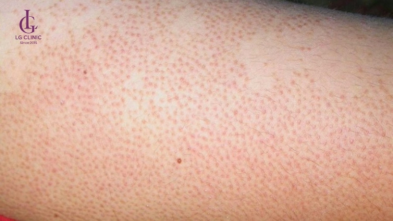 Dấu hiệu thường gặp khi triệt lông bị viêm lỗ chân lông