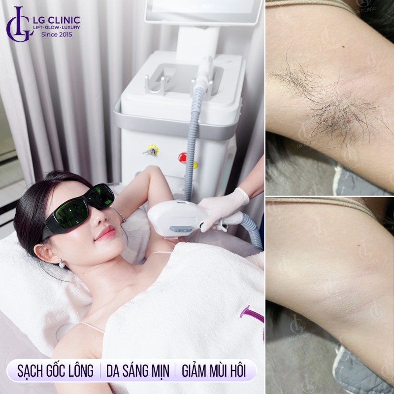 kem tẩy lông nách