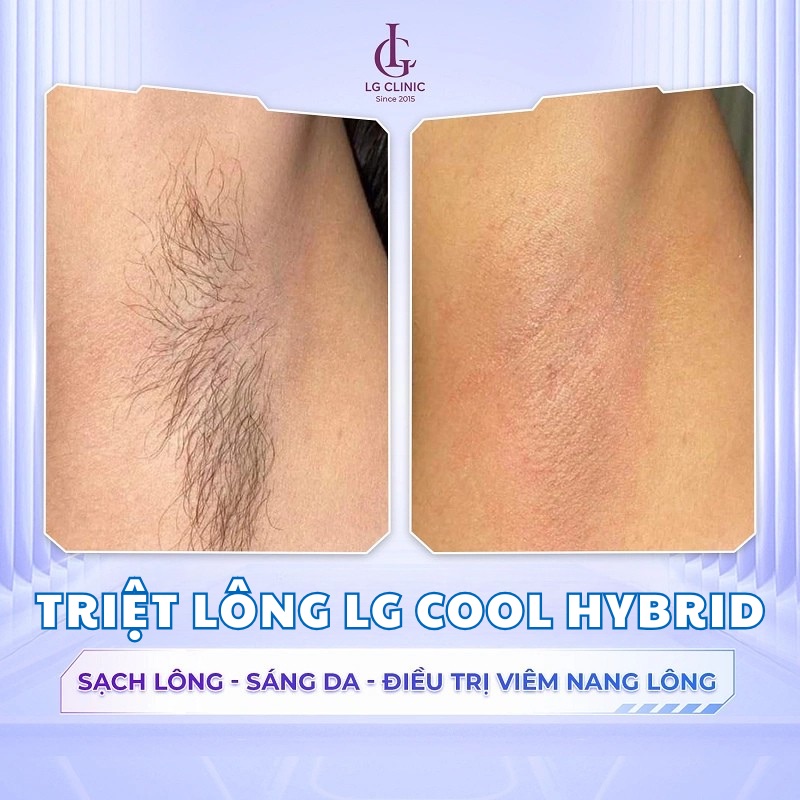 khác biệt trước và sau khi triệt lông nách