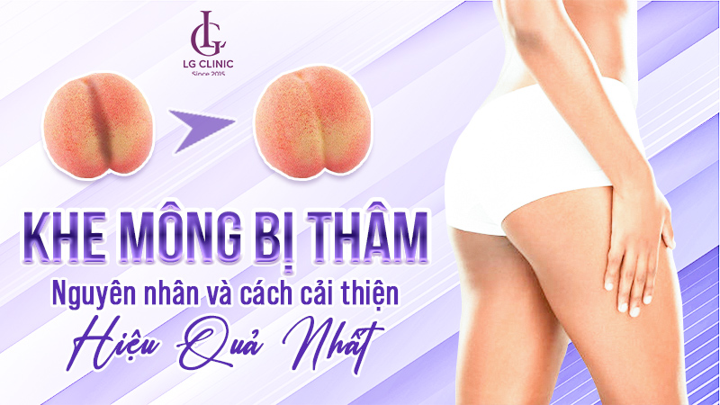 khe mông bị thâm - trị thâm khe mông