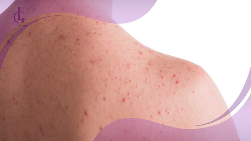 Không chuẩn bị kỹ dễ gây triệt lông bị viêm lỗ chân lông