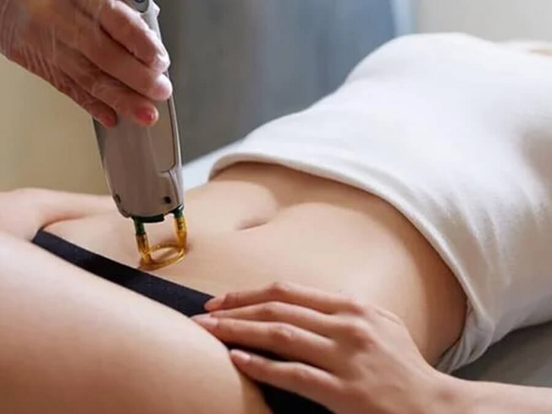 laser trị thâm vùng kín