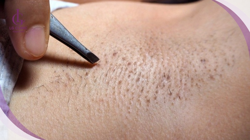 Lông mọc ngược ở nách