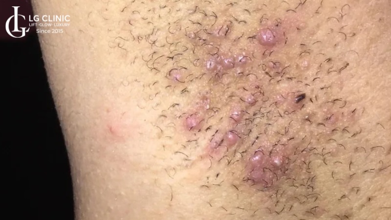 lông nách mọc ngược