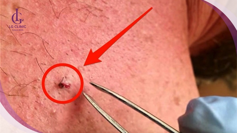 Nách bị lông mọc ngược kèm theo mụn nhỏ có mủ