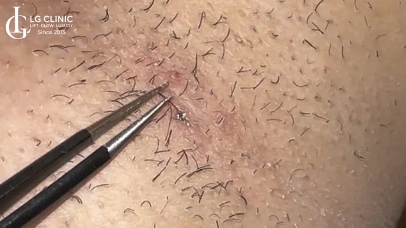 lông nách mọc ngược