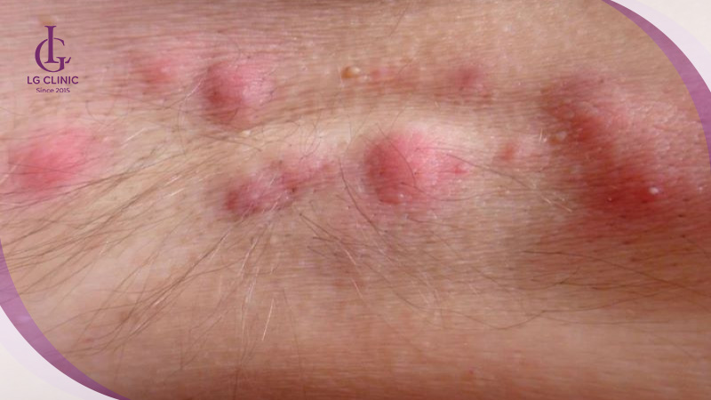 Da nách bị nổi mụn, sưng viêm