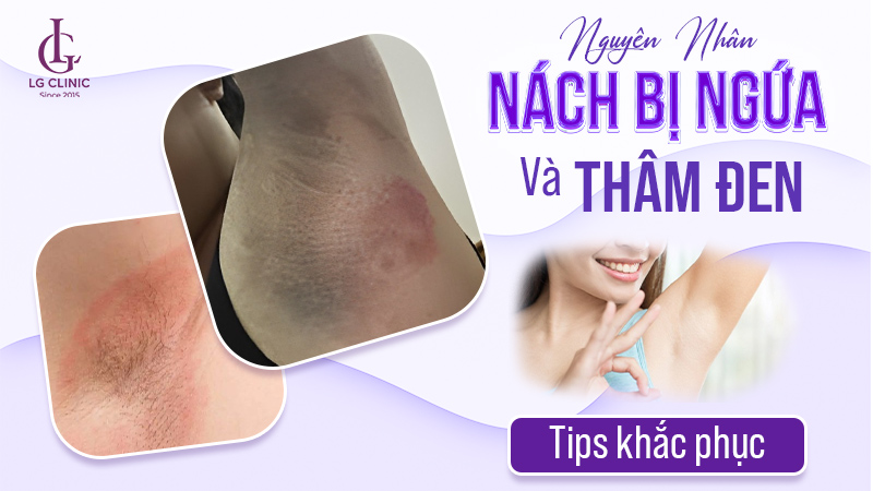 Nách bị ngứa và thâm đen
