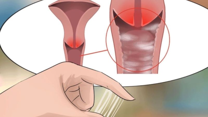 khí hư âm đạo là nguyên nhân vùng kín bị thâm
