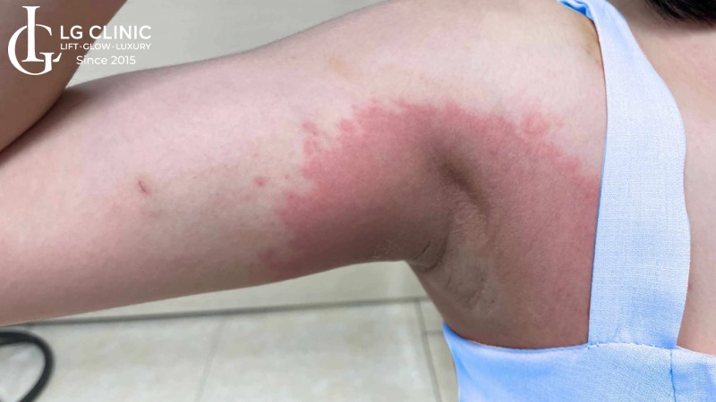peel da trị thâm nách