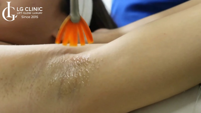 peel da trị thâm nách