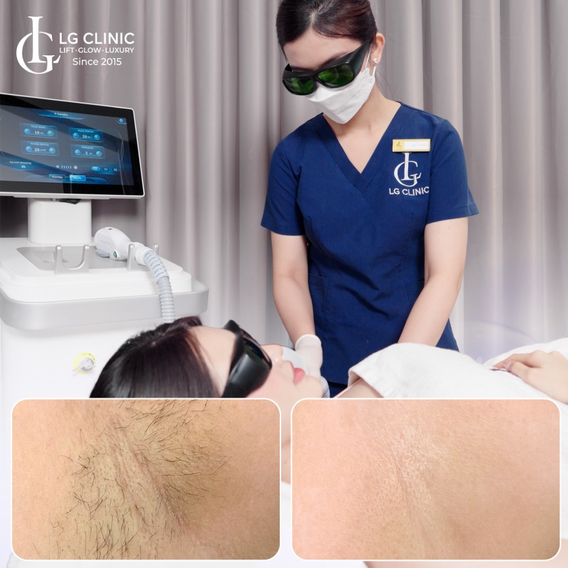 tại sao lông nách mọc nhanh và nhiều