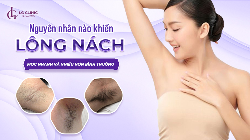 Tại sao lông nách mọc nhanh và nhiều