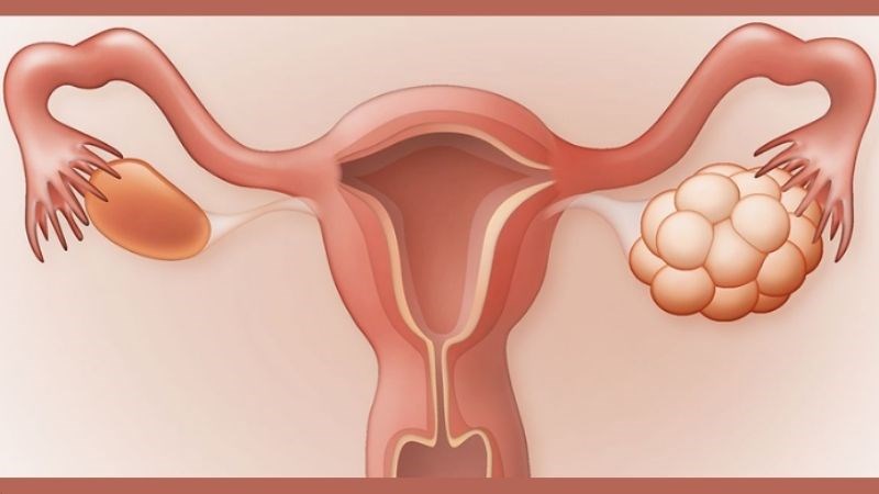 Hội chứng đa nang buồng trứng