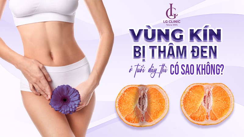 Thâm vùng kín tuổi dậy thì