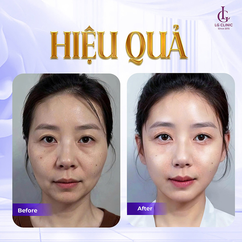 Hình ảnh trước và sau khi tiêm Rejuran của khách hàng tại LG Clinic