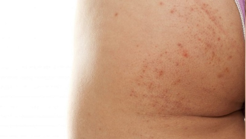 rối loại nội tiết làm mông thâm đen