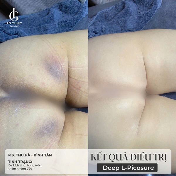 trị thâm mông bằng laser