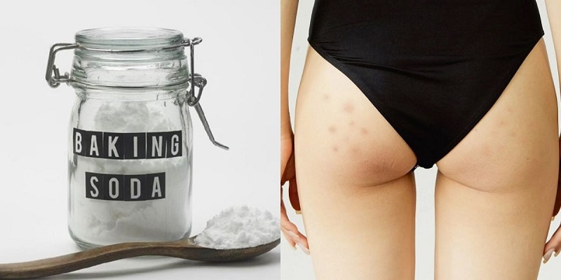 cách trị thâm mông bằng Baking Soda