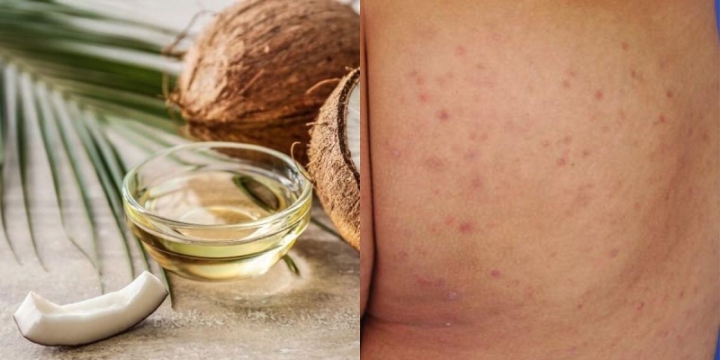 dầu dừa trị thâm mông