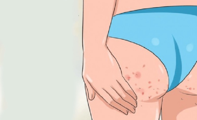 Giá trị thâm mông bằng Laser