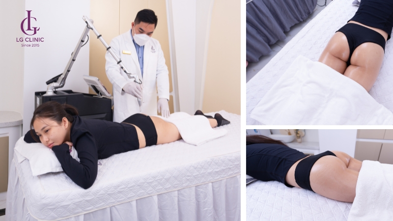 Trị thâm mông tại LG Clinic