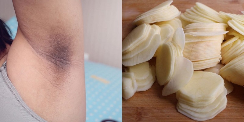 trị thâm nách bằng khoai tây hiệu quả