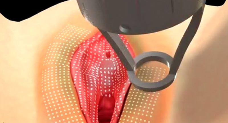laser trị thâm vùng kín