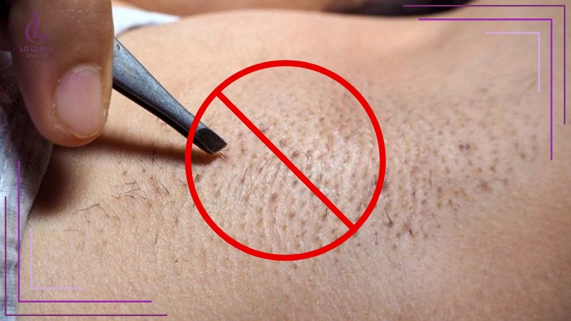 Không nên cạo hay nhổ lông nách khi đang bị viêm