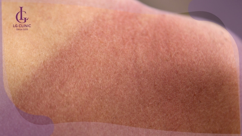 cách làm trắng da bằng vitamin b1 có thể gây bắt nắng