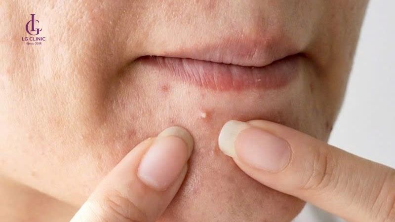nặn mụn là nguyên nhân gây thâm mụn