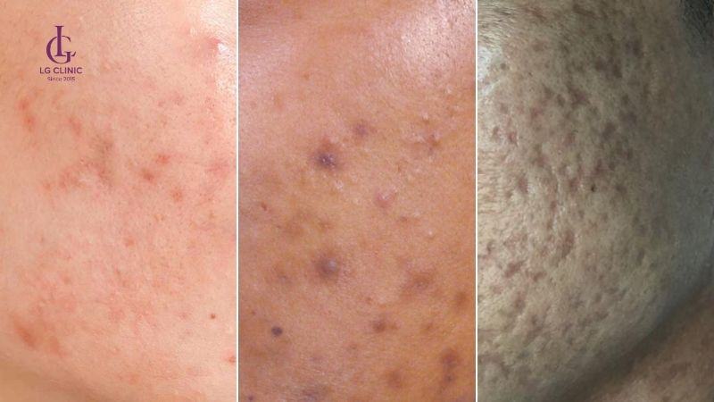 các dạng thâm mụn phổ biến