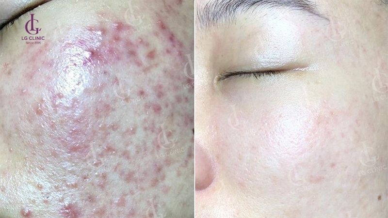 đến bác sĩ da liễu nếu trị thâm mụn không hiệu quả